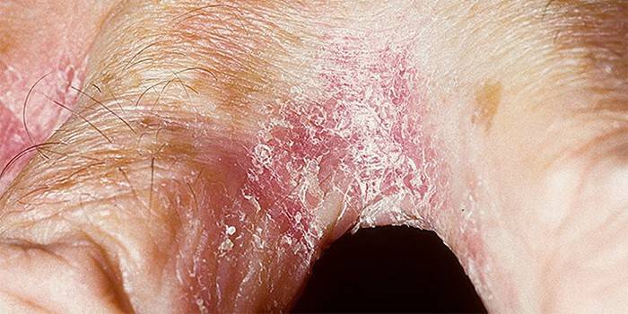 Candidiasis de la piel entre los dedos.