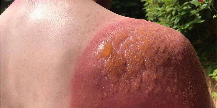 Queimadura solar no ombro de um homem