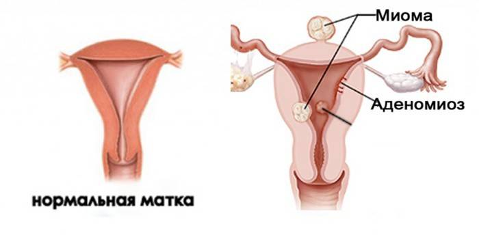 Útero normal e com miomas