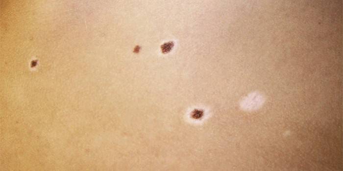 Settonov nevus na ľudskej koži