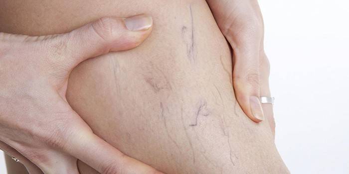 Red vascular en la pierna de una mujer