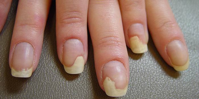 Síndrome de manchas de aceite en las uñas de una mujer.