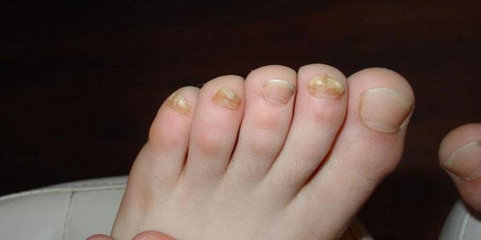 Unhas dos pés afetadas pelo fungo