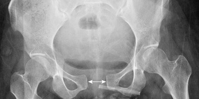 Radiografía de hueso pélvico