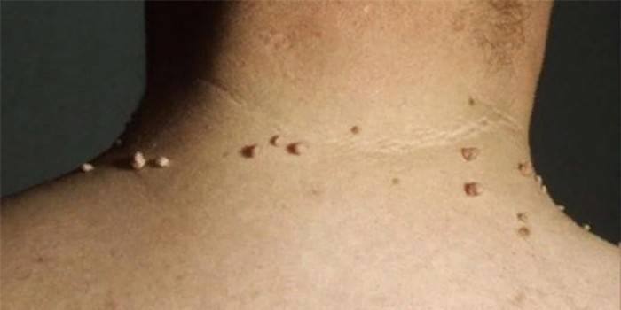 Papillomas no pescoço de um homem