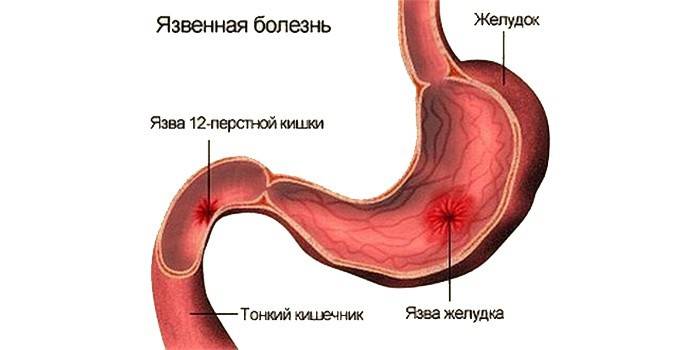 Peptický vred
