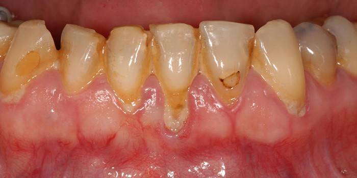 Doença gengival periodontal