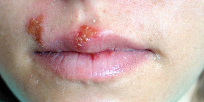 Herpes na hornej pery