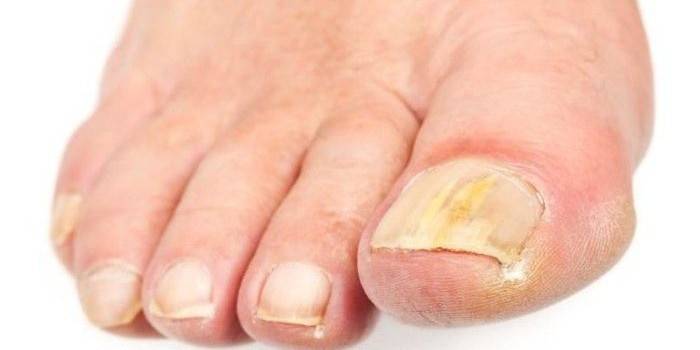 Uñas de los pies afectadas por el hongo