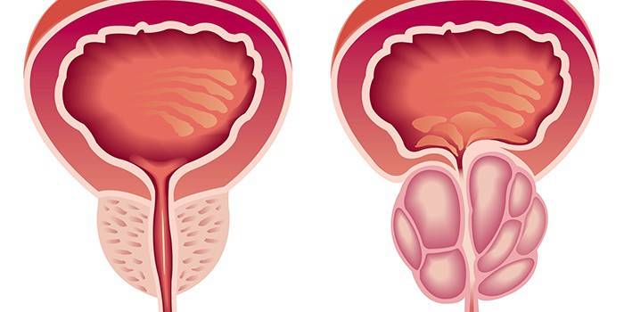 Normálna a zväčšená prostata