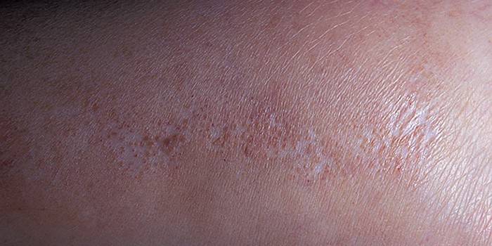 Dermatose na pele humana