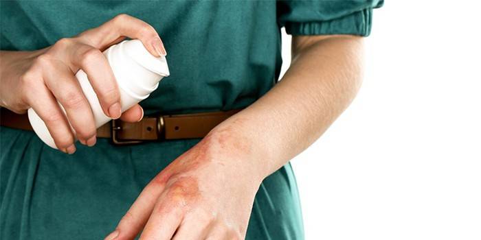 Garota coloca spray de pantenol em uma mão queimada