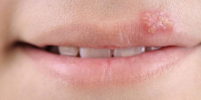 Herpes na horných perách dievčaťa