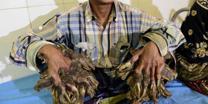 Papilomas raros en manos humanas