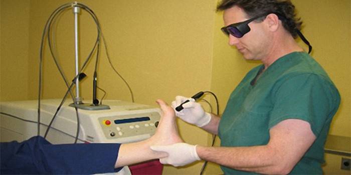 Depilação a laser