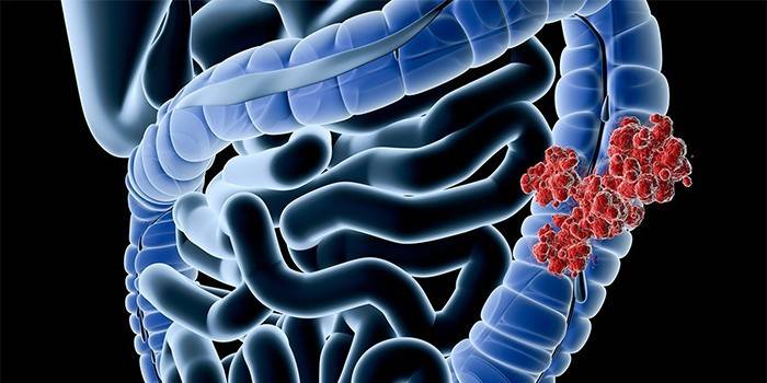 Cáncer de intestino