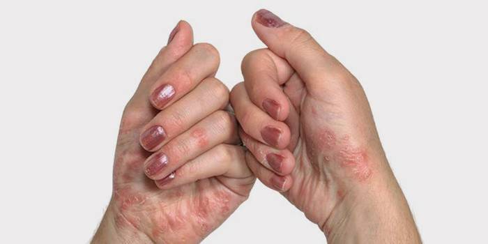 Psoríase nas palmas das mãos femininas