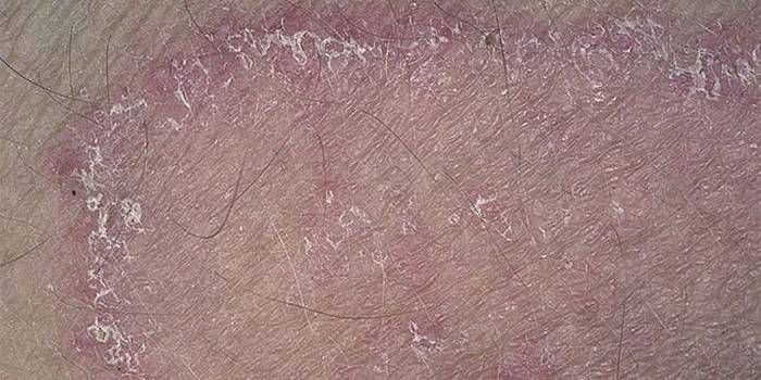 A manifestação da dermatite fúngica na pele de um adulto