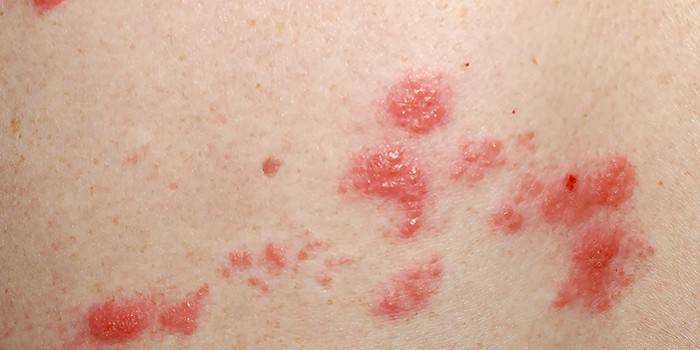 Placas psoriásicas en el cuerpo humano