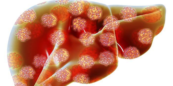 Fígado afetado por hepatite