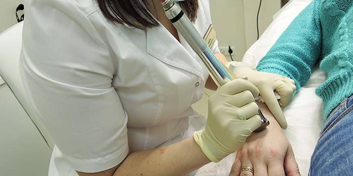 Lekarz usuwa brodawkę za pomocą lasera