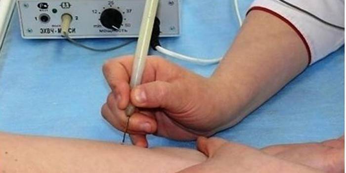 Usunięcie elektrokoagulacji