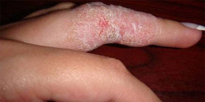 Dermatite fúngica no dedo de uma mulher