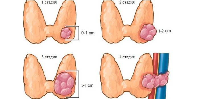 Etapas del cáncer de tiroides.