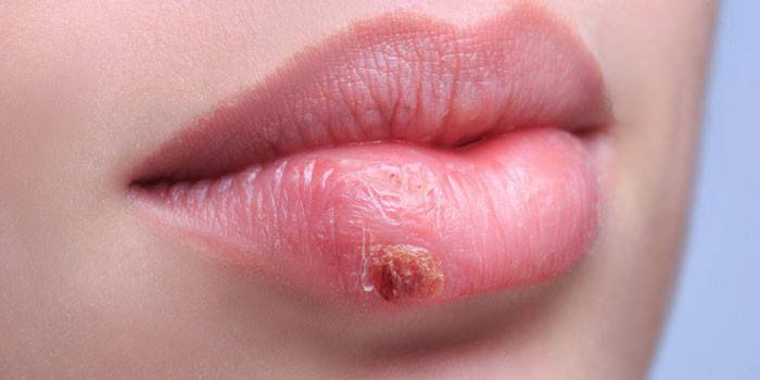 Herpes na spodnej pery dievčaťa