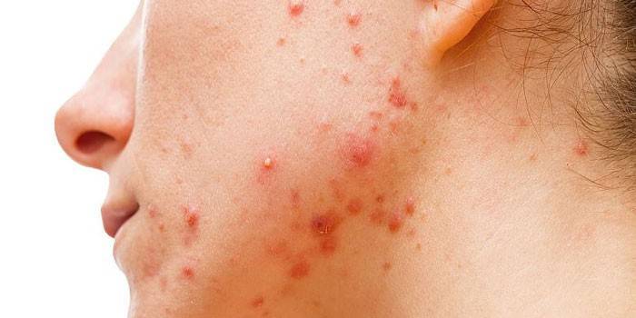 Acne no rosto