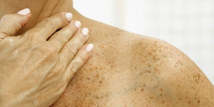 Cloasma no corpo de uma mulher