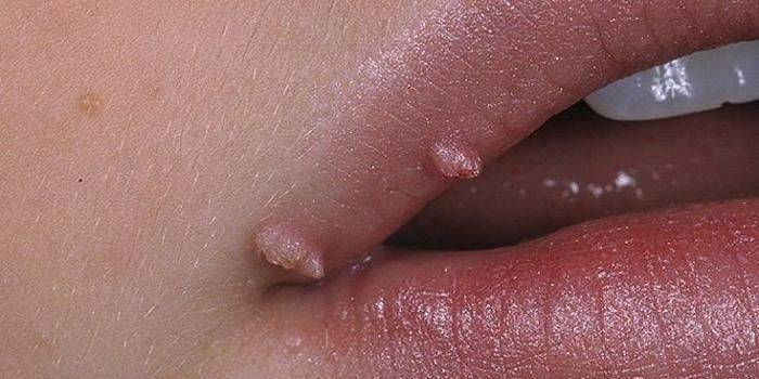 Verrugas genitais no lábio superior de uma menina