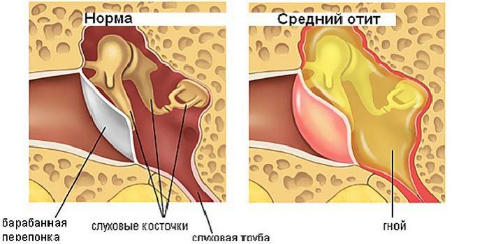 Inflamação auricular