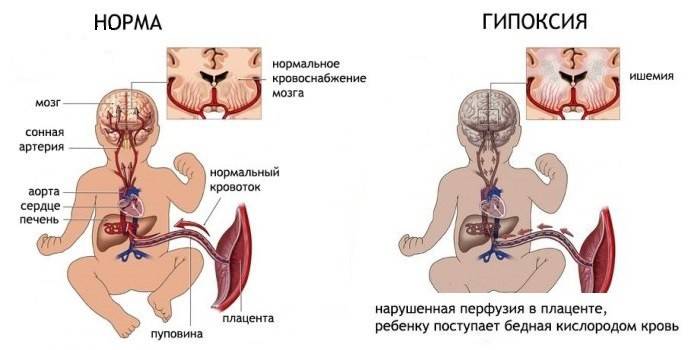 Hypoxia plodu so zníženou perfúziou v placente