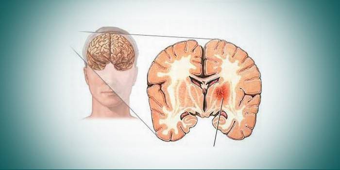 Cerebrálna artérioskleróza