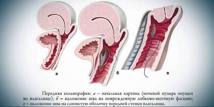 Vaginálna colporafia
