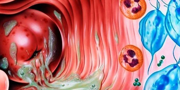 Vaginitis bacteriana