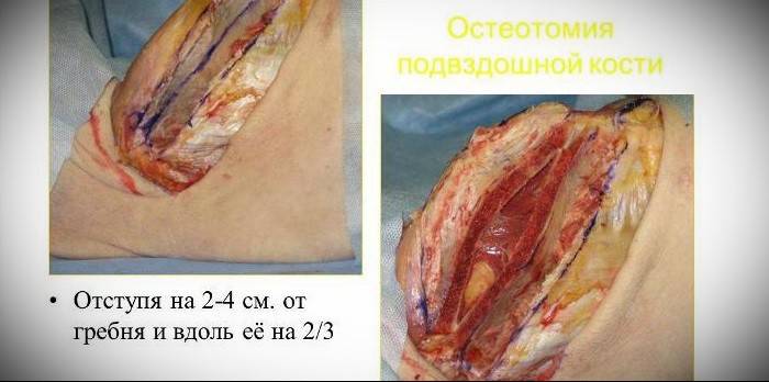 Osteotomía ilíaca