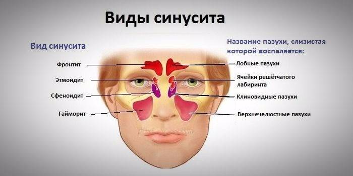 Rodzaje zapalenia zatok
