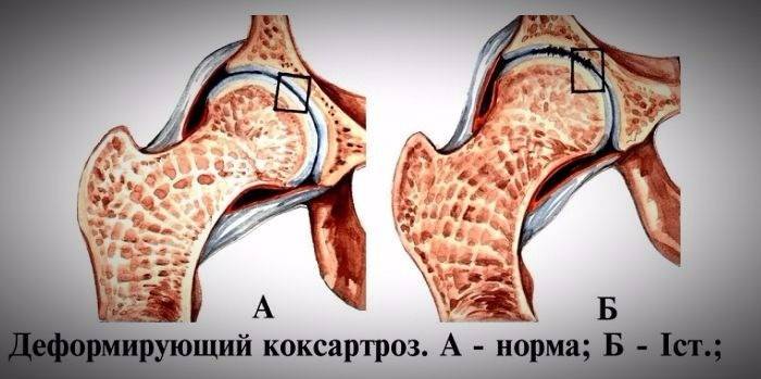 ירך בריאה ומושפעת מעיוות של coxarthrosis