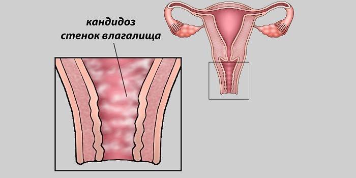 Candidíase vaginal no esquema