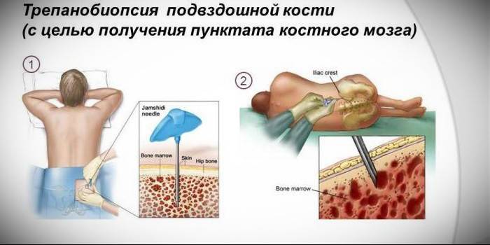 Iris Trepanobiopsia
