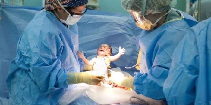 Los médicos realizan una cesárea