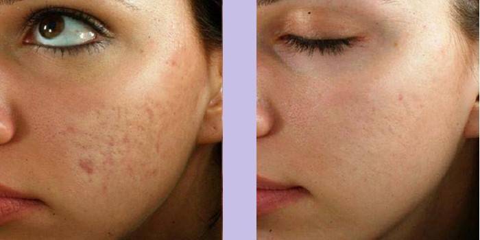 Rosto da mulher antes e depois da massagem