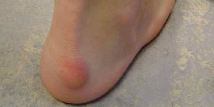 Bata no calcanhar