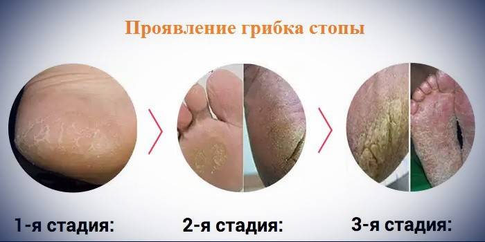Etapy rozwoju grzyba stóp