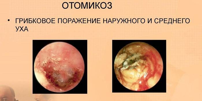 Manifestaciones de otomicosis.
