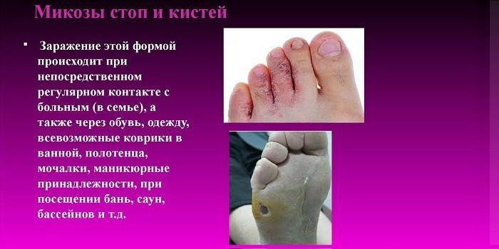 Sposoby infekcji stopy grzybem
