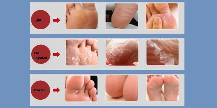 Pára antes, durante e depois do peeling mecânico
