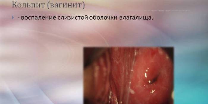 Vaginitis